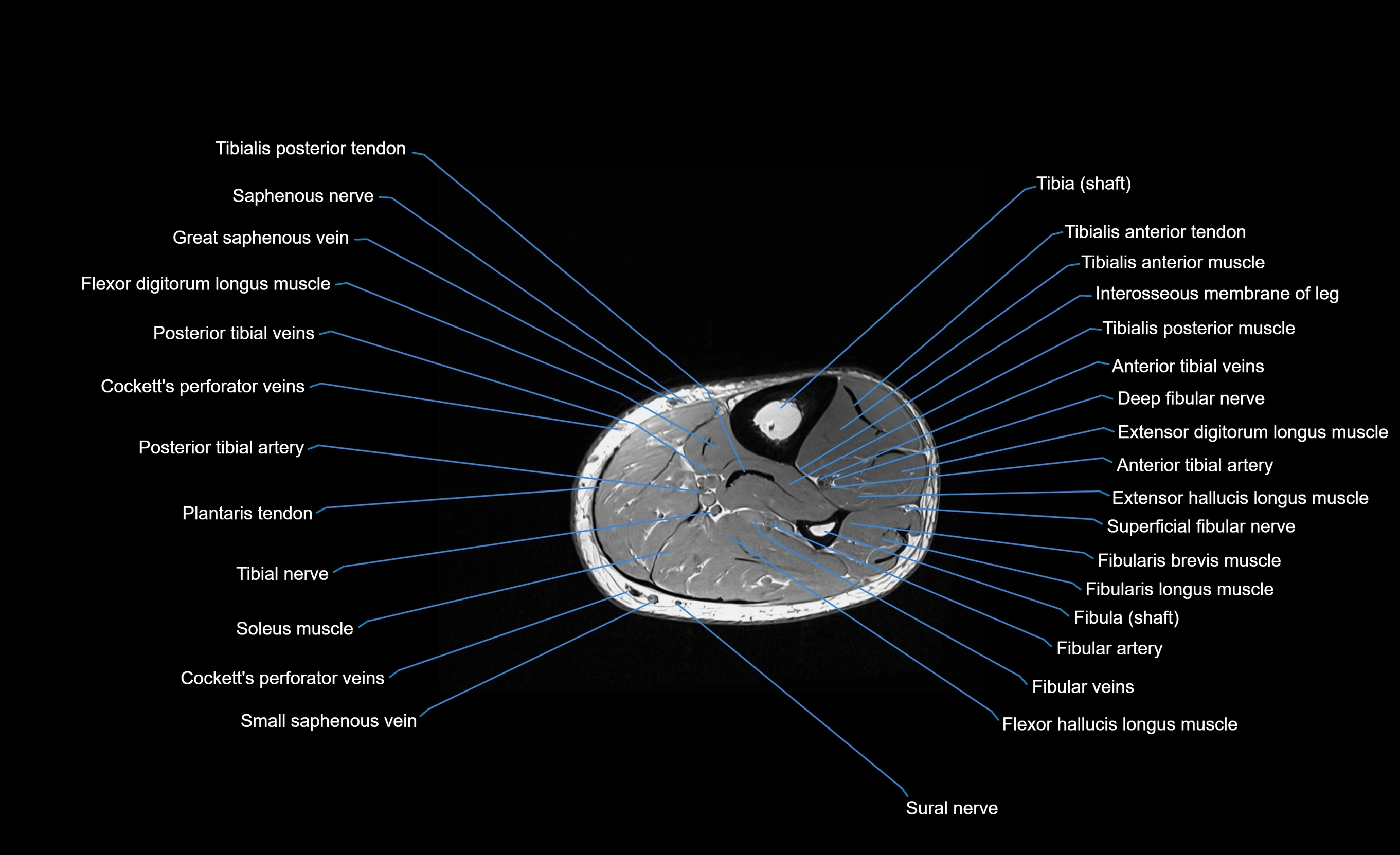 MRI lower leg axial cross sectional anatomy 3T  radiology  image-img-00001-00058.webp